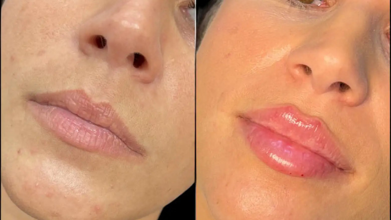 Beginner’s Guide to Getting Fillers in Dubai