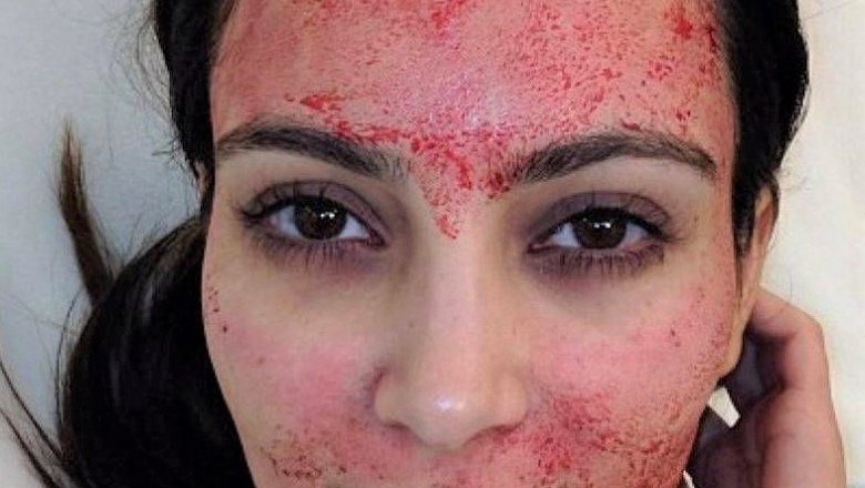 What Does the Vampire Facial Procedure Feel Like?