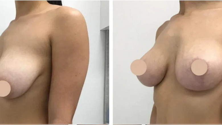 Achieve the Best Results with the Best Doctors in Dubai for Breast Reduction