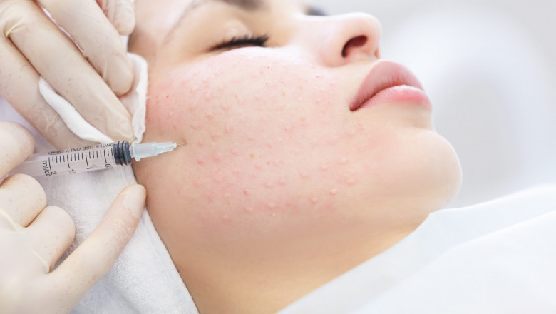 How Mesotherapy Helps Reduce Cellulite and Fat Deposits