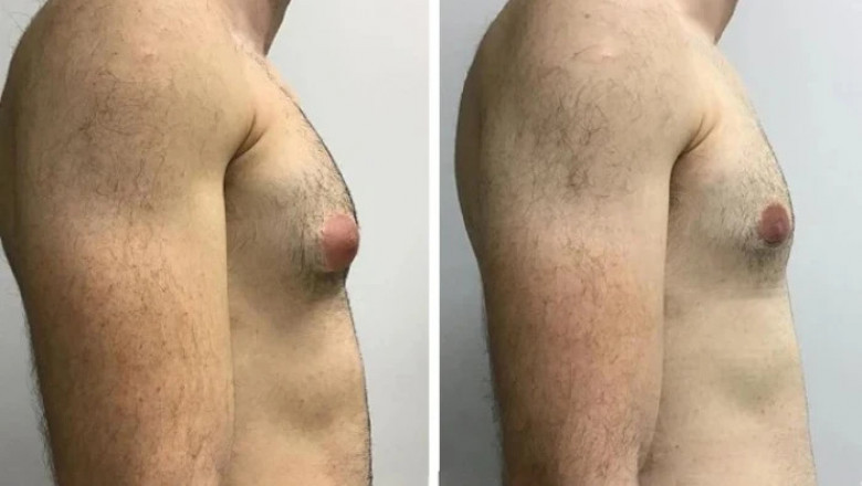 How the Best Doctors in Dubai Help You Achieve Your Ideal Chest Appearance After Gynecomastia Surgery