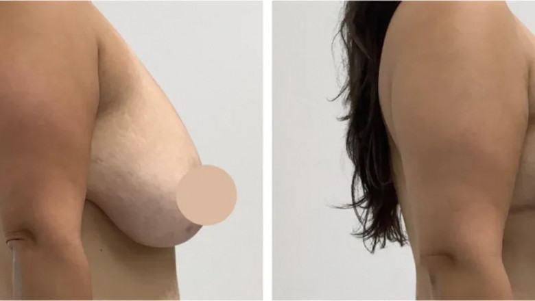 What Makes Breast Lift in Dubai So Effective? Best Doctors in Dubai Explain