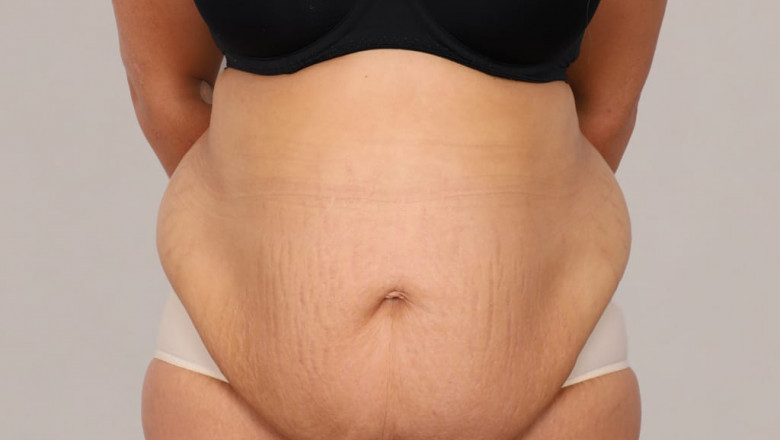 Do I Need Liposuction with My Tummy Tuck?