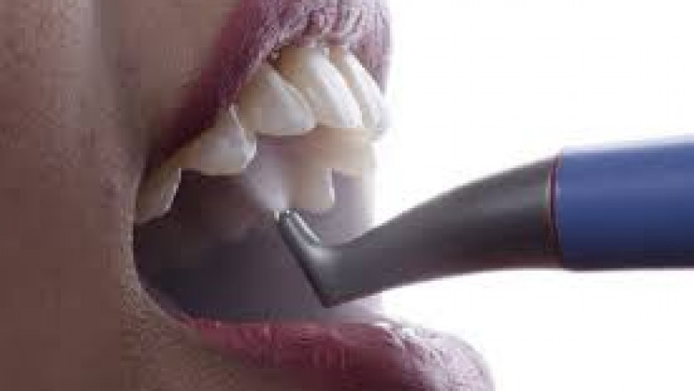 Does Insurance Cover Teeth Polishing?