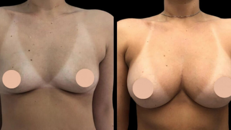 Where to Stay During Your Breast Augmentation in Dubai Journey
