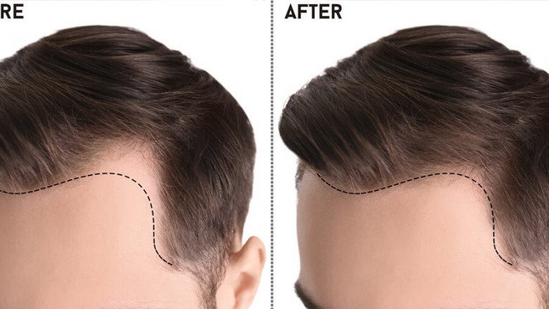 The Apex of Follicular Excellence: Unraveling the Best Hair Transplant in Islamabad